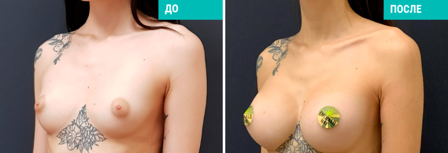 Маммопластика 