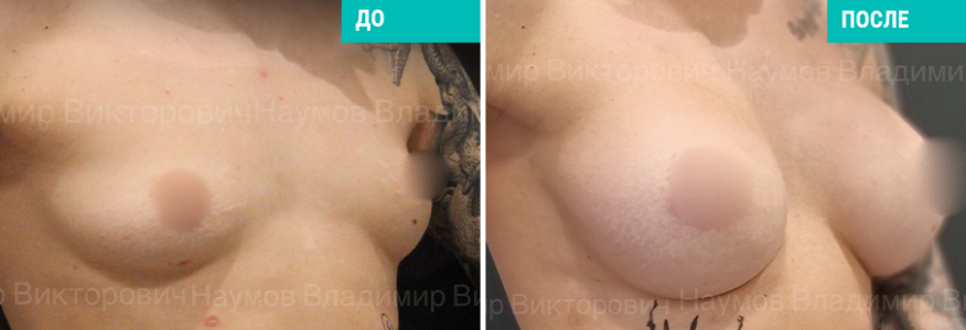 Увеличение груди
