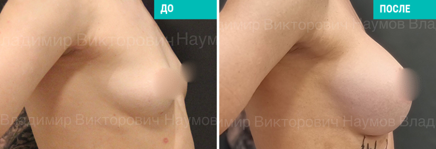 Увеличение груди