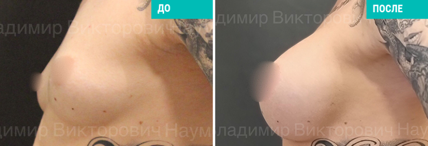 Увеличение груди