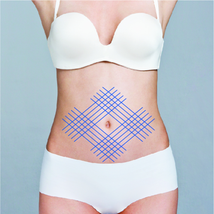 Нитевой лифтинг тела: когда он нужен?