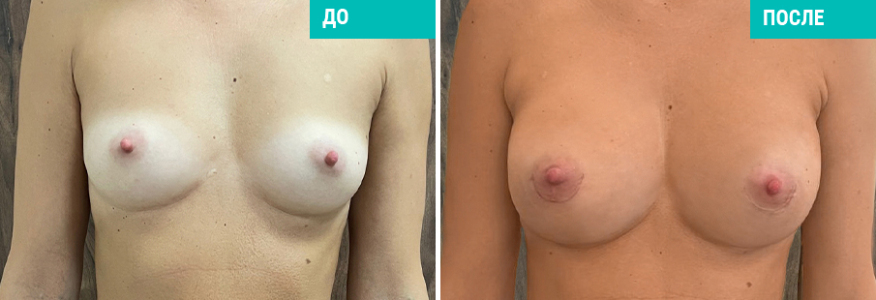 Маммопластика