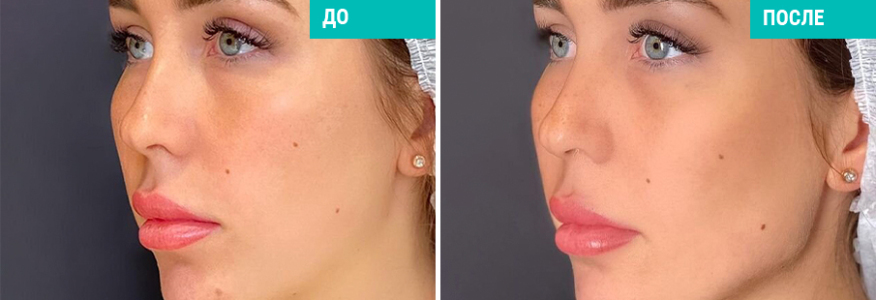 Контурная пластика углов челюсти