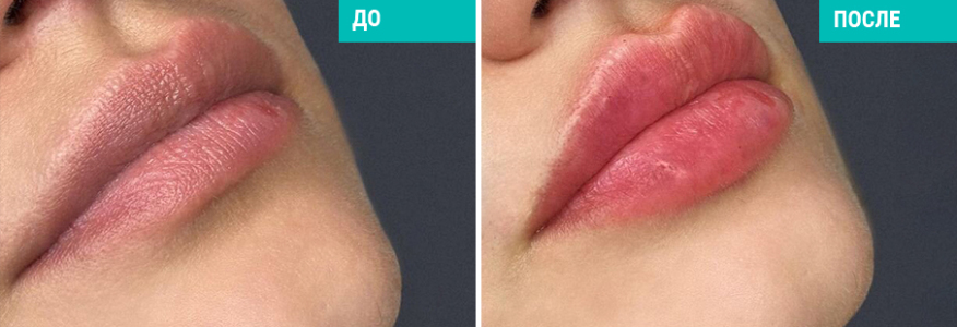 Контурная пластика