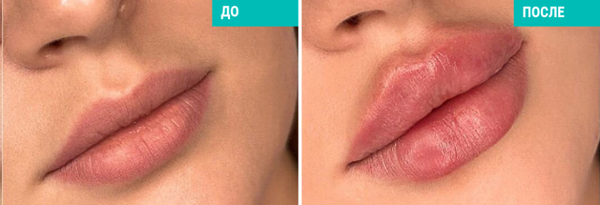 Контурная пластика