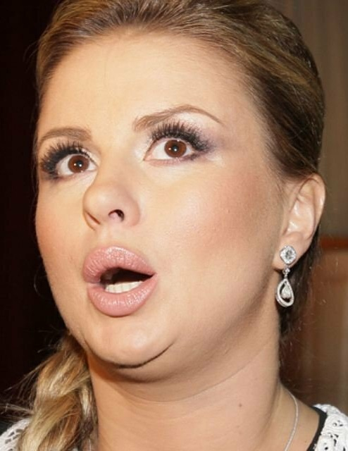 Липосакция Анны Семенович