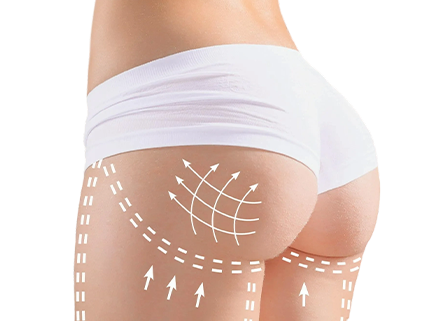 Подтяжка нитями ягодиц