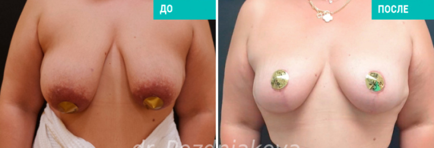 Подтяжка груди