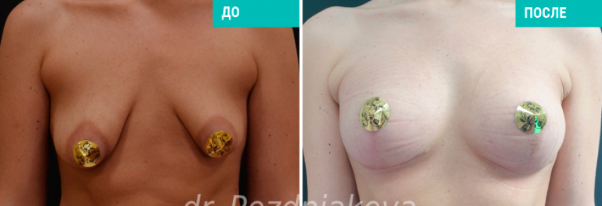 Подтяжка груди с установкой имплантов