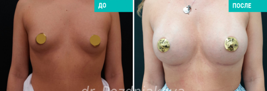 Увеличение груди с помощью имплантов