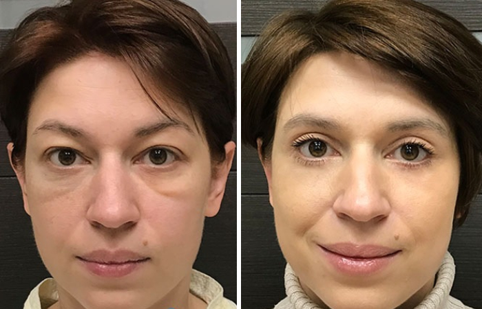 Как убрать малярные мешки? - 300 экспертов.РУ