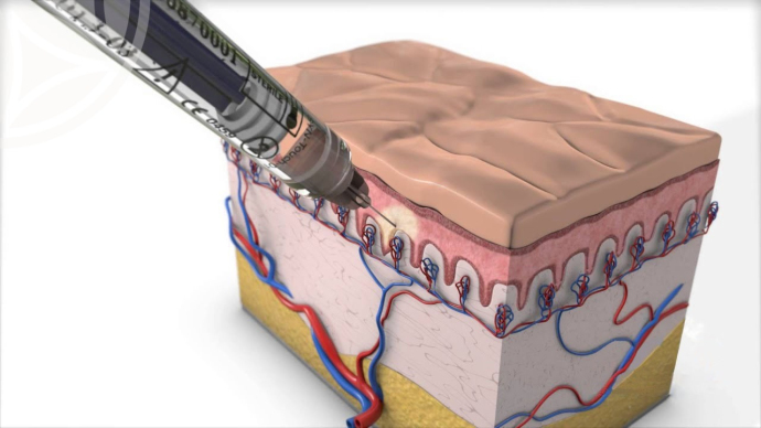Инъекции коллагена