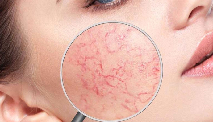 Как удалить сосудистые звездочки