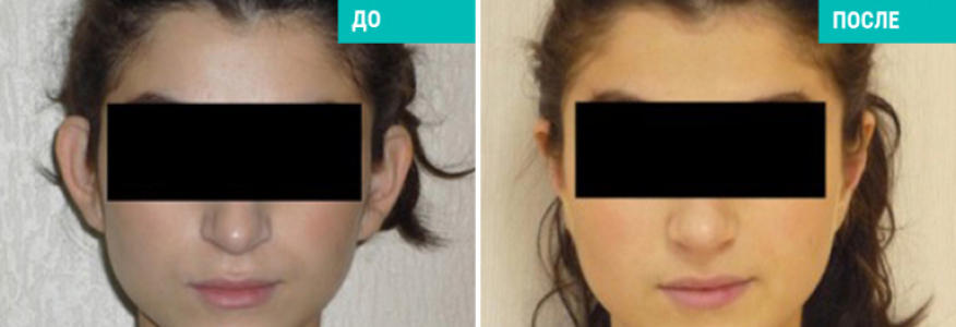 Отопластика