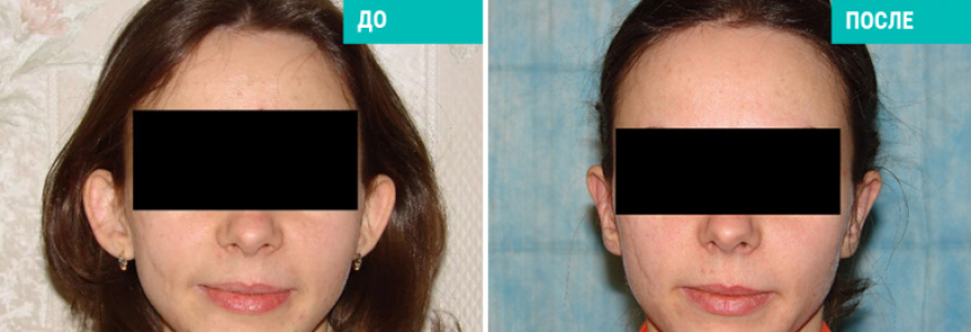 Отопластика