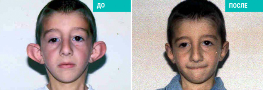 Отопластика