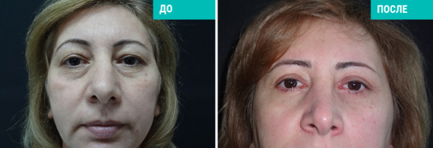 Блефаропластика