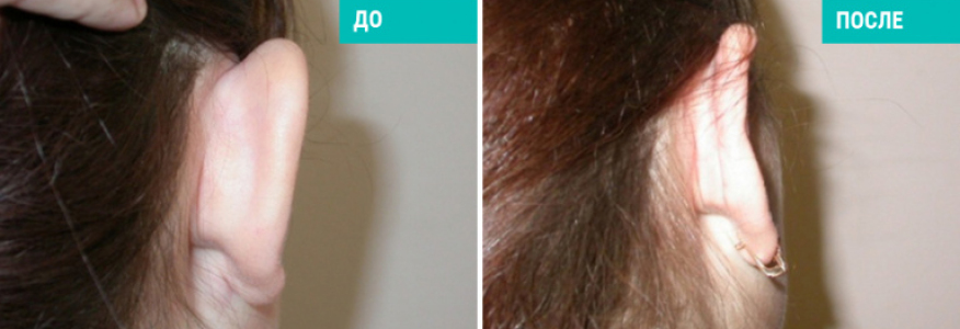 Отопластика