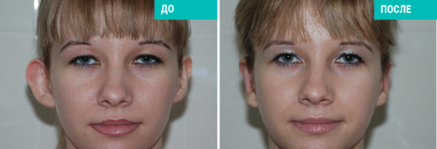 Отопластика