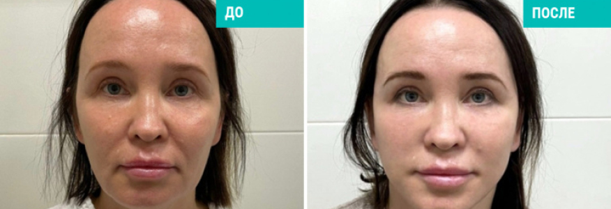 Смас подтяжка лица, платизмопластика,подтяжка шеи. 2 месяца после операции