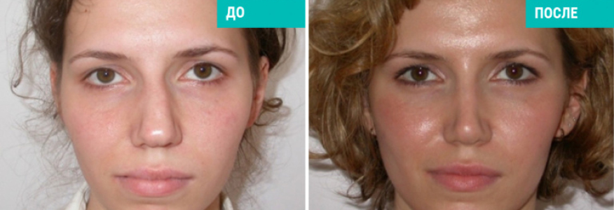 Ринопластика