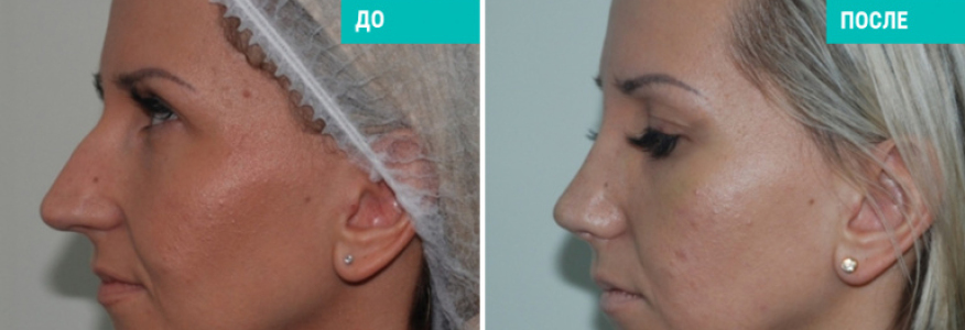 Ринопластика (3 недели после операции)