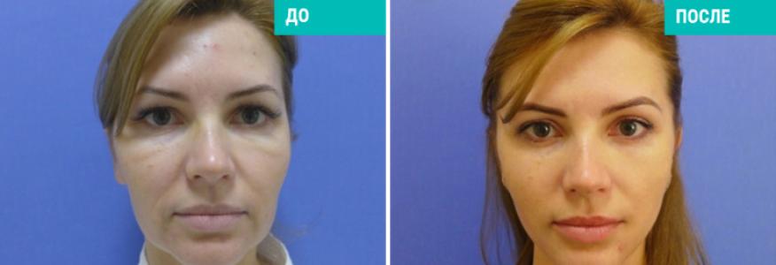 Височный лифтинг+нитевая подтяжка, круговая блефаропластика, удаление малярных мешков. 1,5 месяца после операции