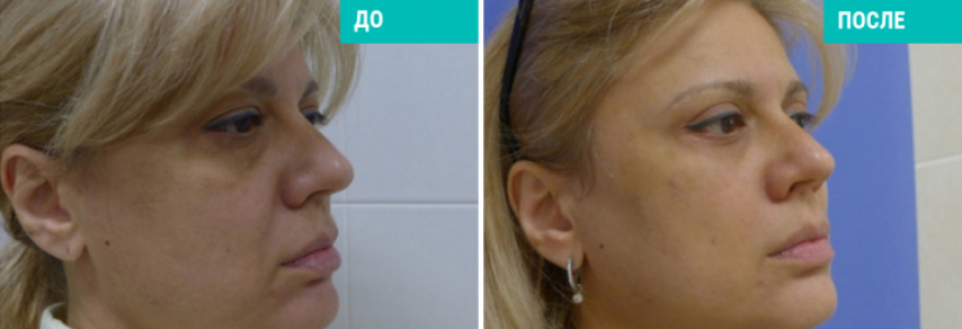 Выполнен комплекс операций : височный лифтинг с постановкой нитей Силуэт Лифт, круговая блефаропластика, платизмопластика, удаление малярных мешков, липосакция подбородка. 2 месяца после операции