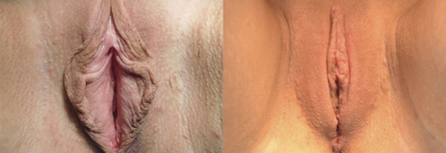 Интимная пластика