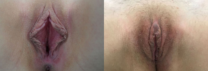 Интимная пластика