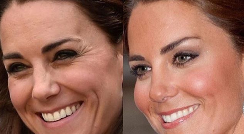 Кейт Миддлтон до и после «детского ботокса»