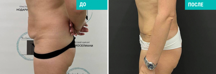 Абдоминопластика