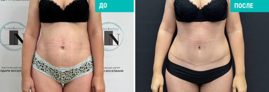 Абдоминопластика