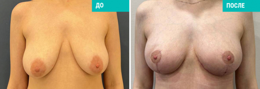 Подтяжка груди