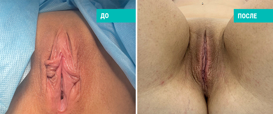 Фото пациентки Н. Б. Иоселиани до и после лабиопластики
