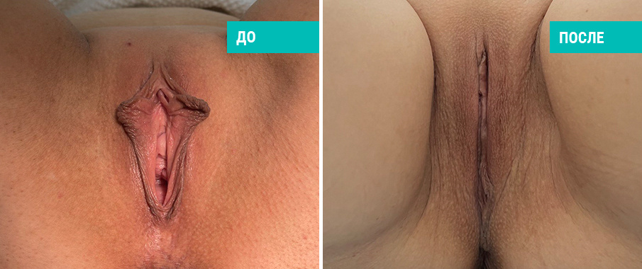 Фото пациентки Н. Б. Иоселиани до и после лабиопластики