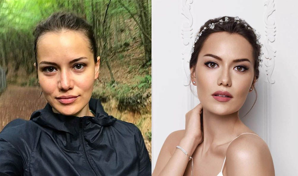 Благодаря аккуратной коррекции носа исчез круглый кончик, ноздри сузились, заметно изменилась спинка