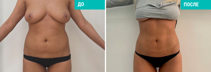 Липосакция живота и боков