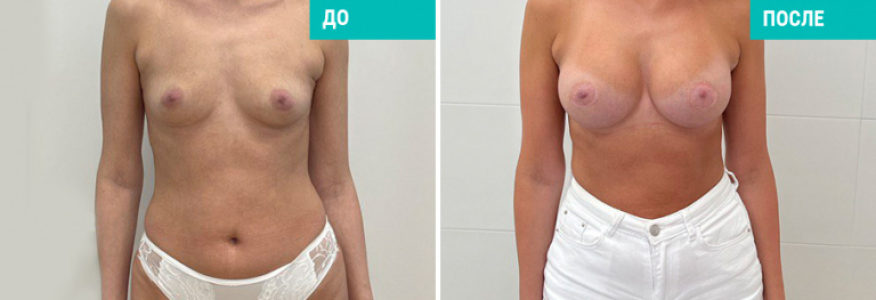 Увеличение груди