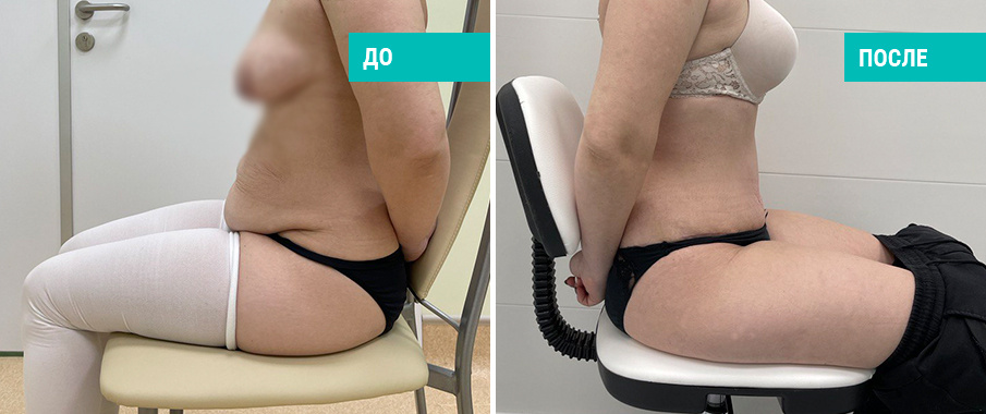 Фото пациентки Н. Б. Иоселиани до и после абдоминопластики