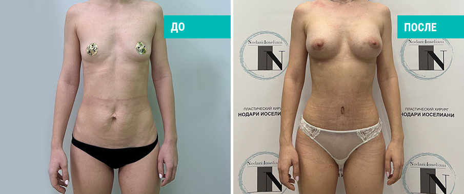 Фото пациентки Н. Б. Иоселиани до и после комплексного восстановления (маммопластика + абдоминопластика)