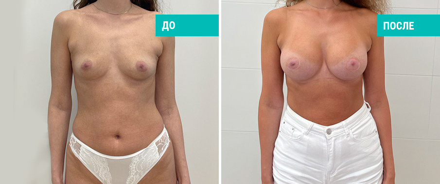 Фото пациентки Н. Б. Иоселиани до и после увеличения груди с помощью имплантов