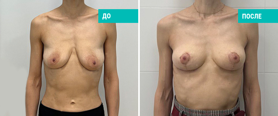 Фото пациентки Н. Б. Иоселиани до и после подтяжки груди без установки имплантов
