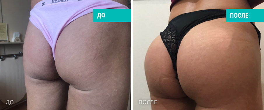 Пациентка  Д. В. Крысина до и после операции