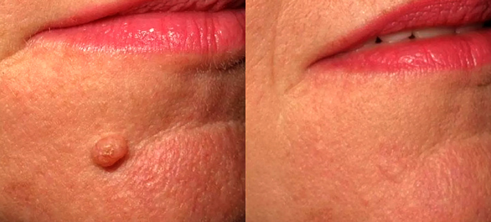 До и после радиоволнового удаления родинки. Специалист Колганов Станислав Евгеньевич