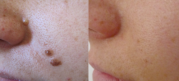 До и после радиоволнового удаления родинки. Специалист Новиков Михаил Владимирович