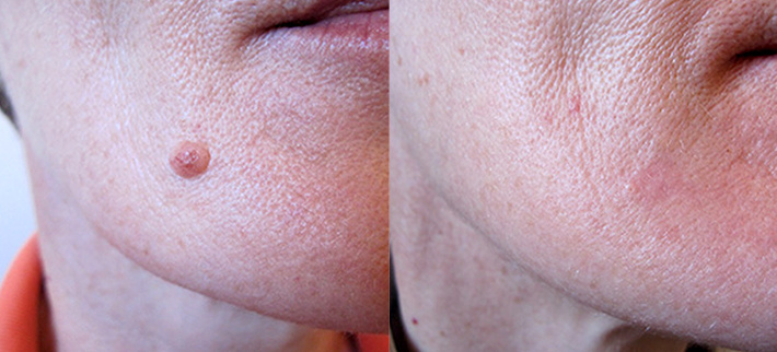 До и посде лазерного удаления родинки. Специалист Воротникова Ирина Валентиновна