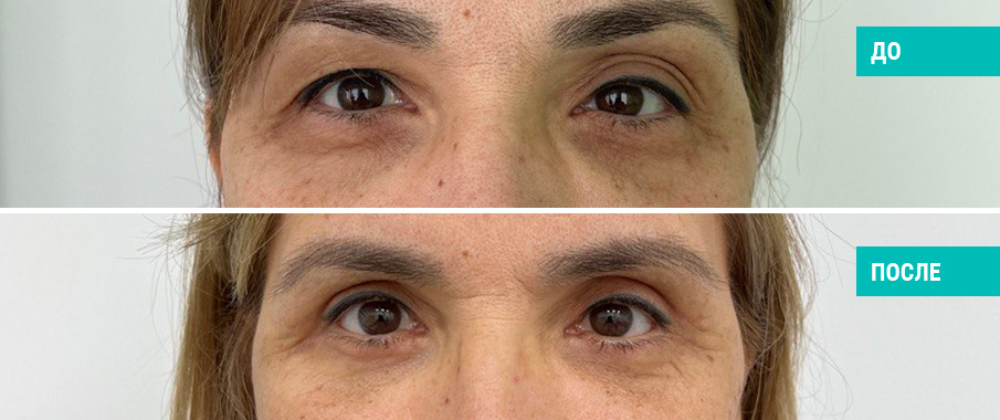 До и после круговой блефаропластики. Пластический хирург Н. Б. Иоселиани