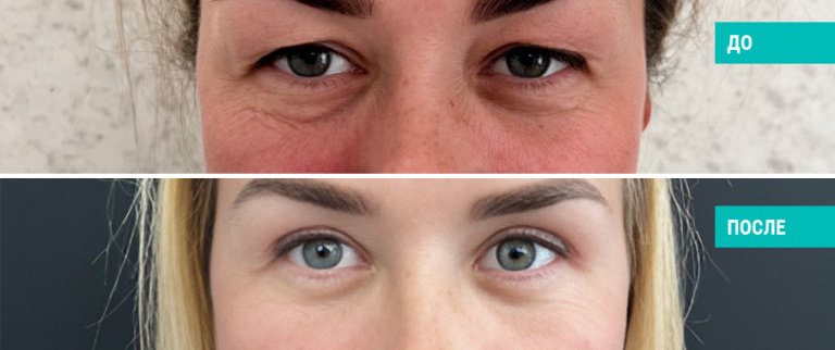 До и после круговой блефаропластики. Пластический хирург Н. Б. Иоселиани