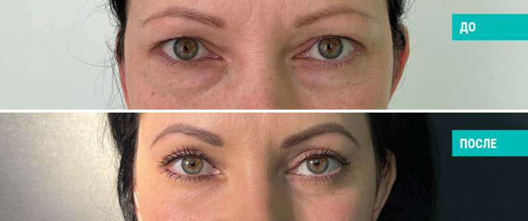 До и после круговой блефаропластики. Пластический хирург Н. Б. Иоселиани